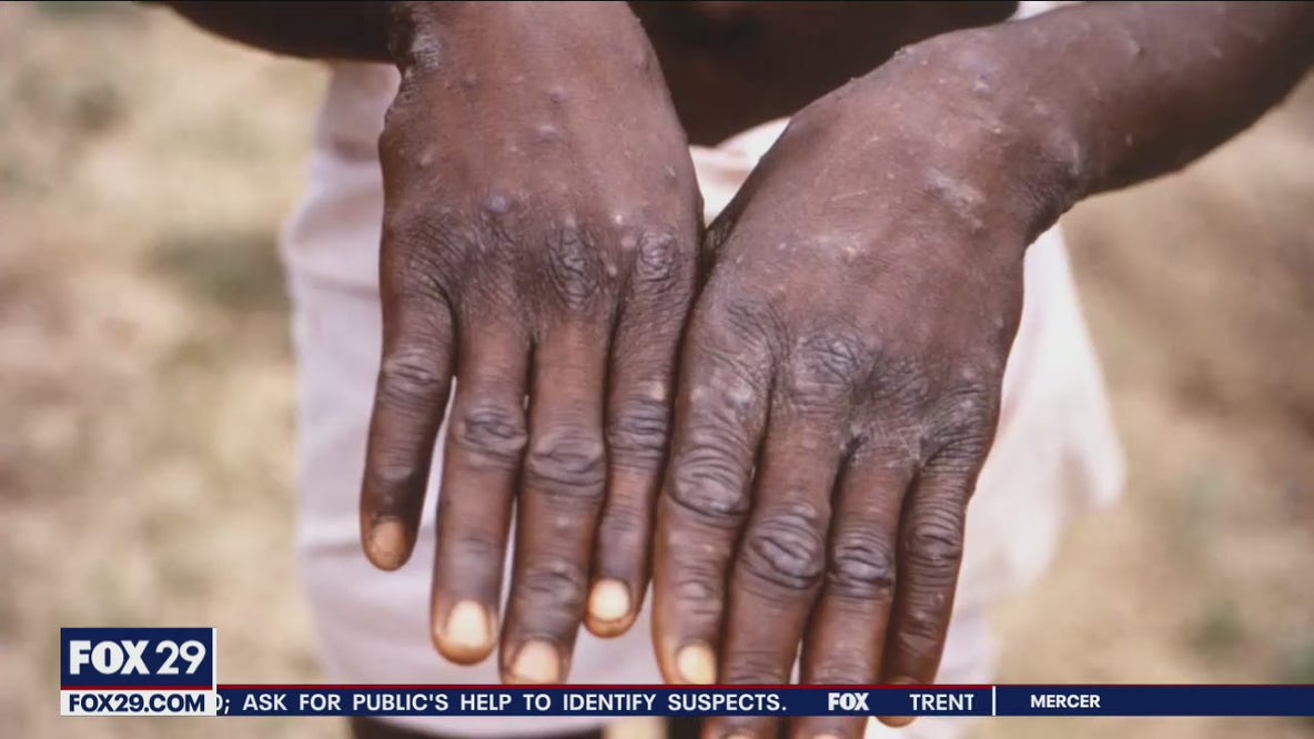 Monkeypox: Experts explain rare disease after case found in U.S.